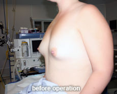 plastic-surgery-breast-augmentation